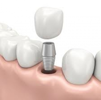 chi phi cay ghep rang implant gia bao nhieu tien 