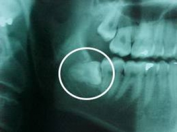 bien chung cua nho rang khon