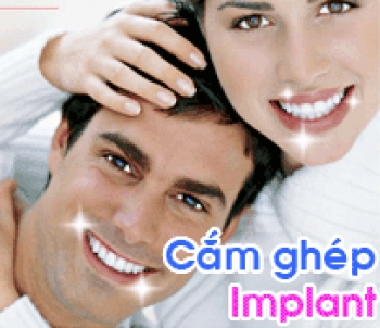implant chi phi cho implant  nhung uu diem va nhuoc diem cua ky thuat implant