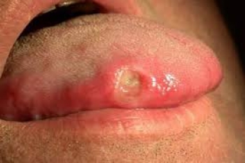 95  benh nhan phat hien ung thu luoi o giai doan cuoi
