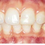 Healthygums 150x150 Bệnh nha chu không chỉ gây mất răng