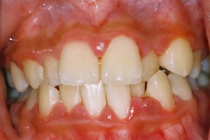 Gingivitis 300x200 Bệnh nha chu không chỉ gây mất răng