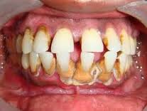 Healthygums 300x200 Bệnh nha chu không chỉ gây mất răng